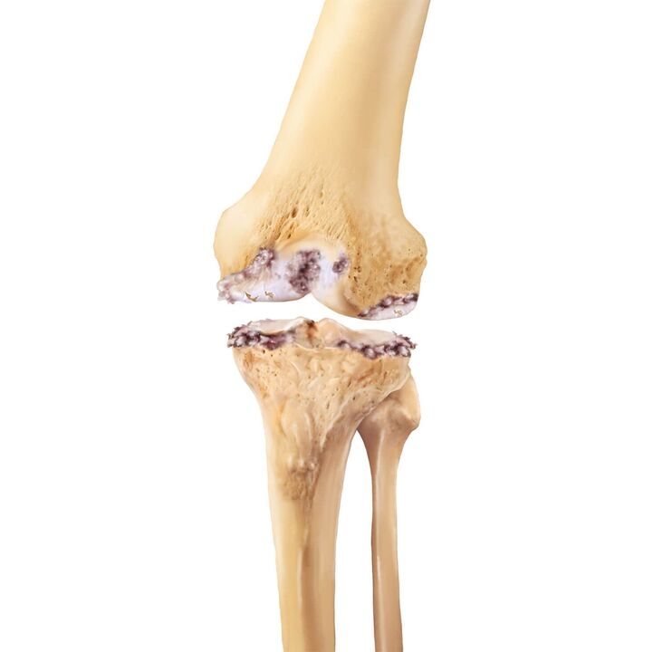 destrucción de la articulación de la rodilla con artrosis