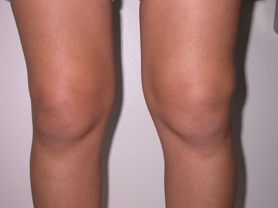 hinchazón de la rodilla debido a la osteoartritis