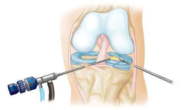 En la última etapa del desarrollo, la artrosis se trata quirúrgicamente. 
