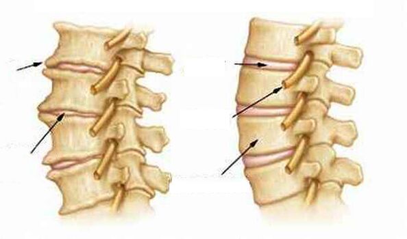 ¿Qué es la osteocondrosis