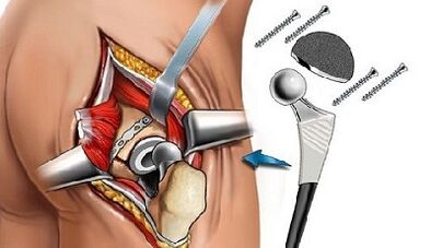 Endoprotética para la artrosis de la cadera