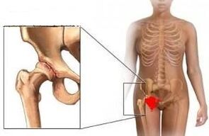 Las razones para el desarrollo de la artrosis de la articulación de la cadera