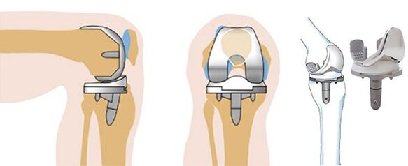 Operación endoprótica de la articulación de la rodilla para la artrosis