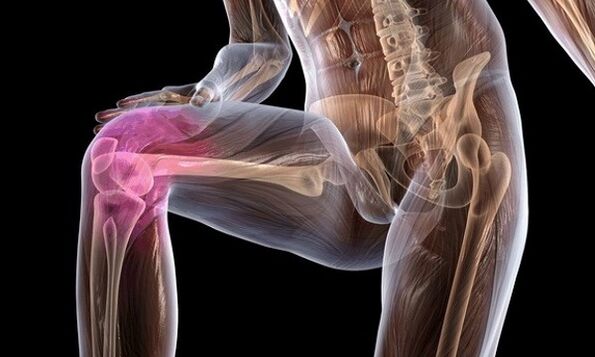 Signos y síntomas de la artrosis de la articulación de la rodilla