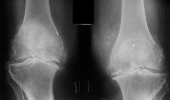 X -rayar como una forma de diagnosticar la artrosis de la articulación de la rodilla