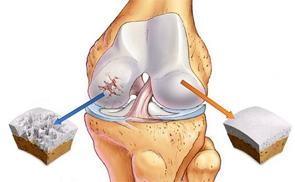 norma y desviación para la artrosis de la articulación de la rodilla