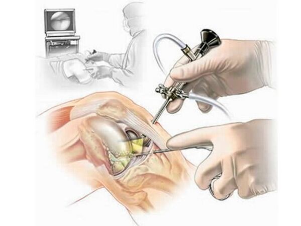 Artroscopia de la articulación de la rodilla