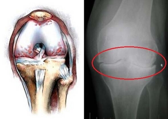 La deformación de la articulación de la rodilla para la artrosis