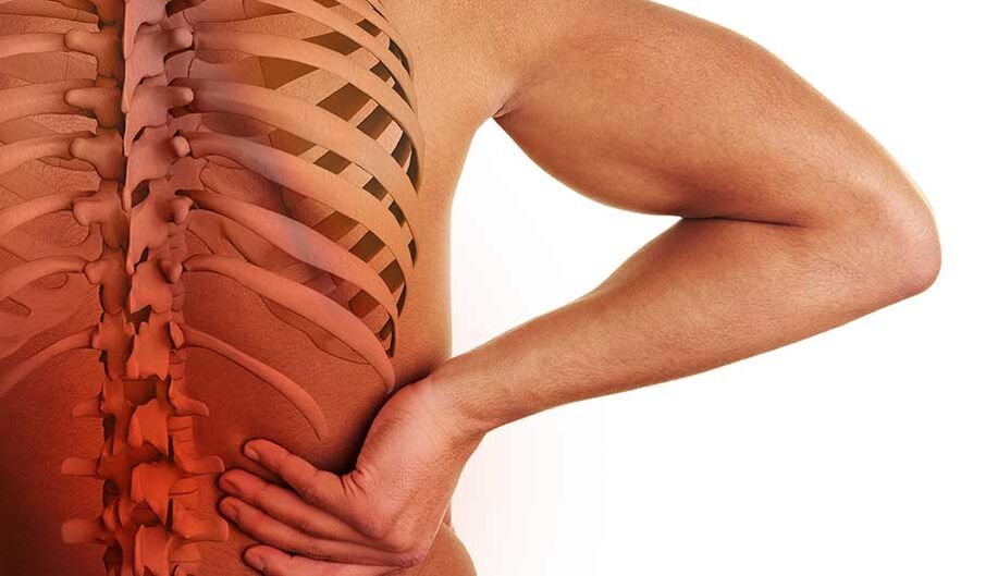 Osteocondrosis de la columna lumbar.