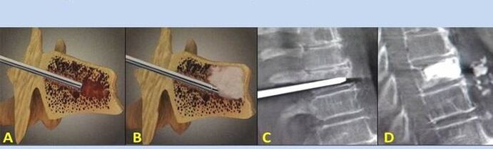 vertebroplastia por punción para el dolor de espalda