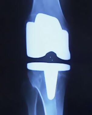 Radiografía de una rodilla con una prótesis artificial después de una cirugía de reemplazo articular