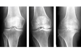 etapas de la artrosis de la articulación en una radiografía