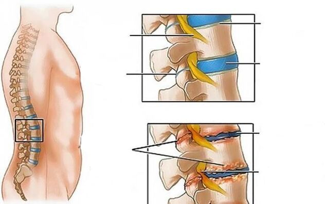 osteocondrosis de la columna lumbar causa dolor de espalda