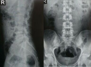 radiografía de la columna lumbar